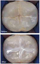 before and after photo of sealant on a tooth